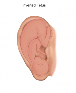 Inverted Fetus