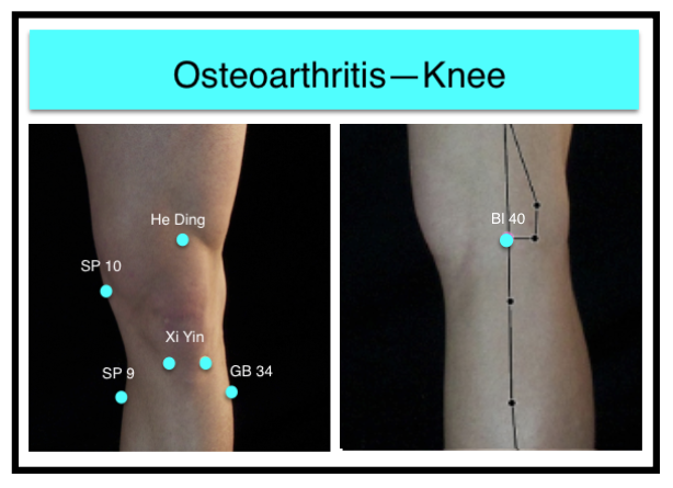 Osteoarthritis--Knee