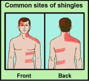 Success with Shingles
