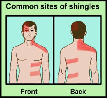 You Don't Treat This Every Day - Success with Shingles!