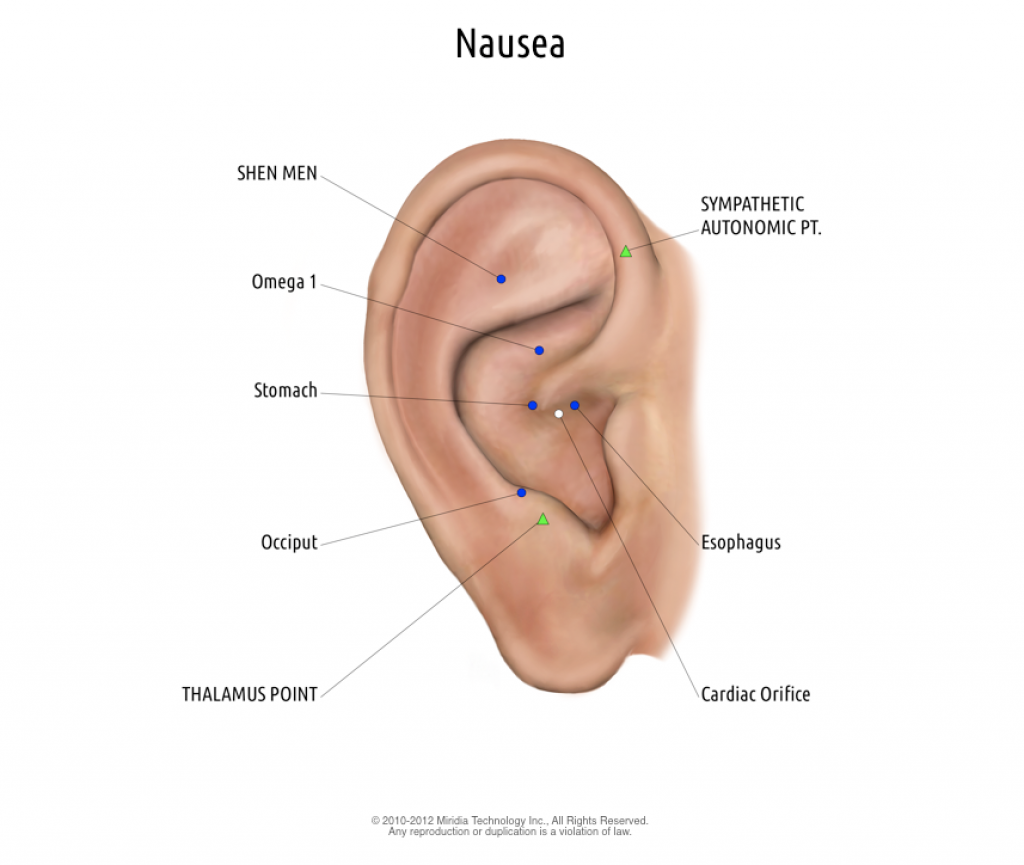Nausea protocol in Auriculo 3D. Treat with Stimplus Pro