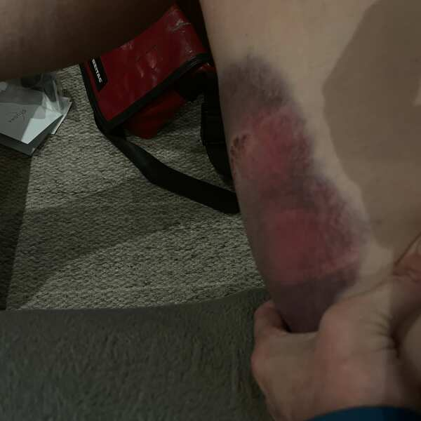 Bruise showing lightened areas treated with Photizo