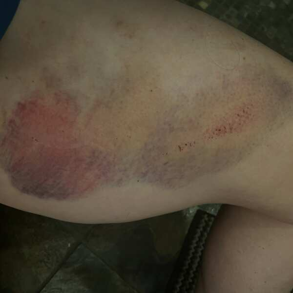 Bruise showing lighter treated areas and dark untreated area