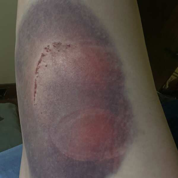 Lightened areas of bruise treated with Photizo