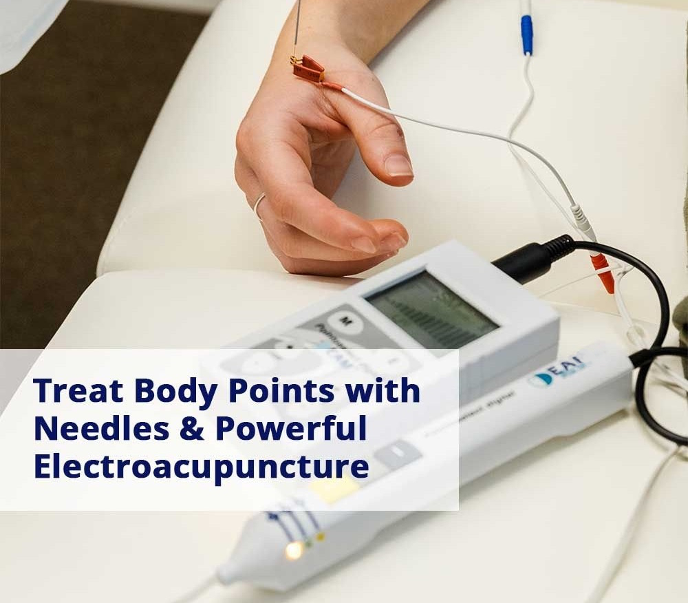 Treating with Electroacupuncture